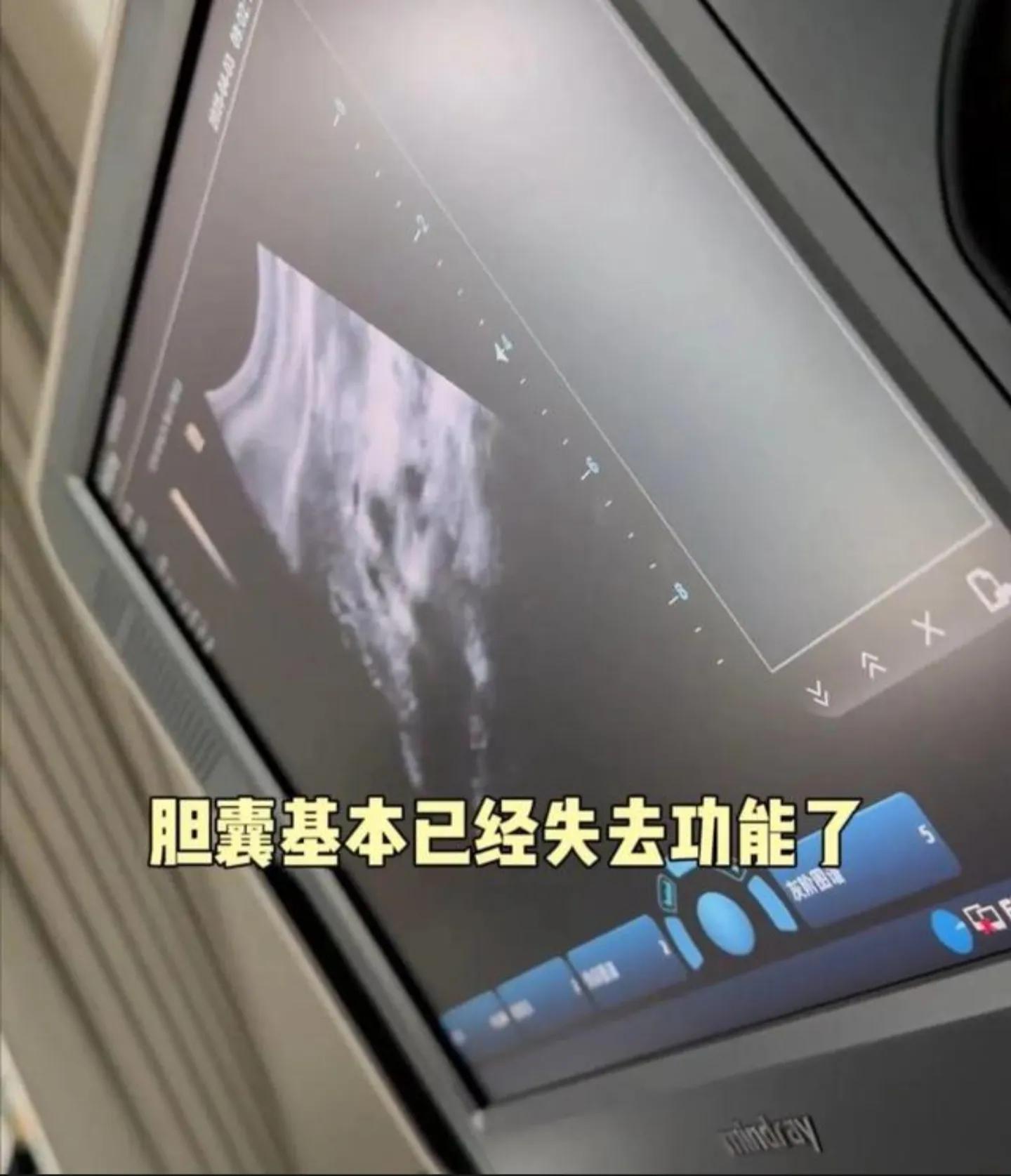 女演員穎兒因腹部劇痛切除膽囊
